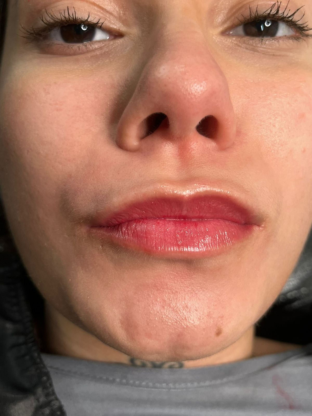 Resultado após procedimento 1