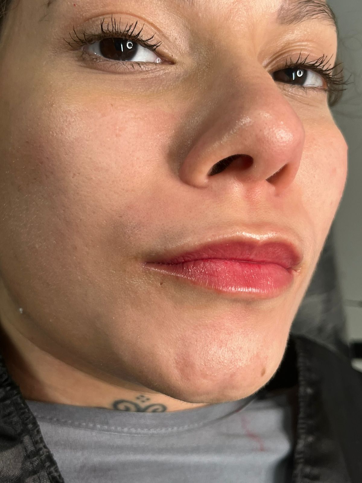 Resultado após procedimento 2