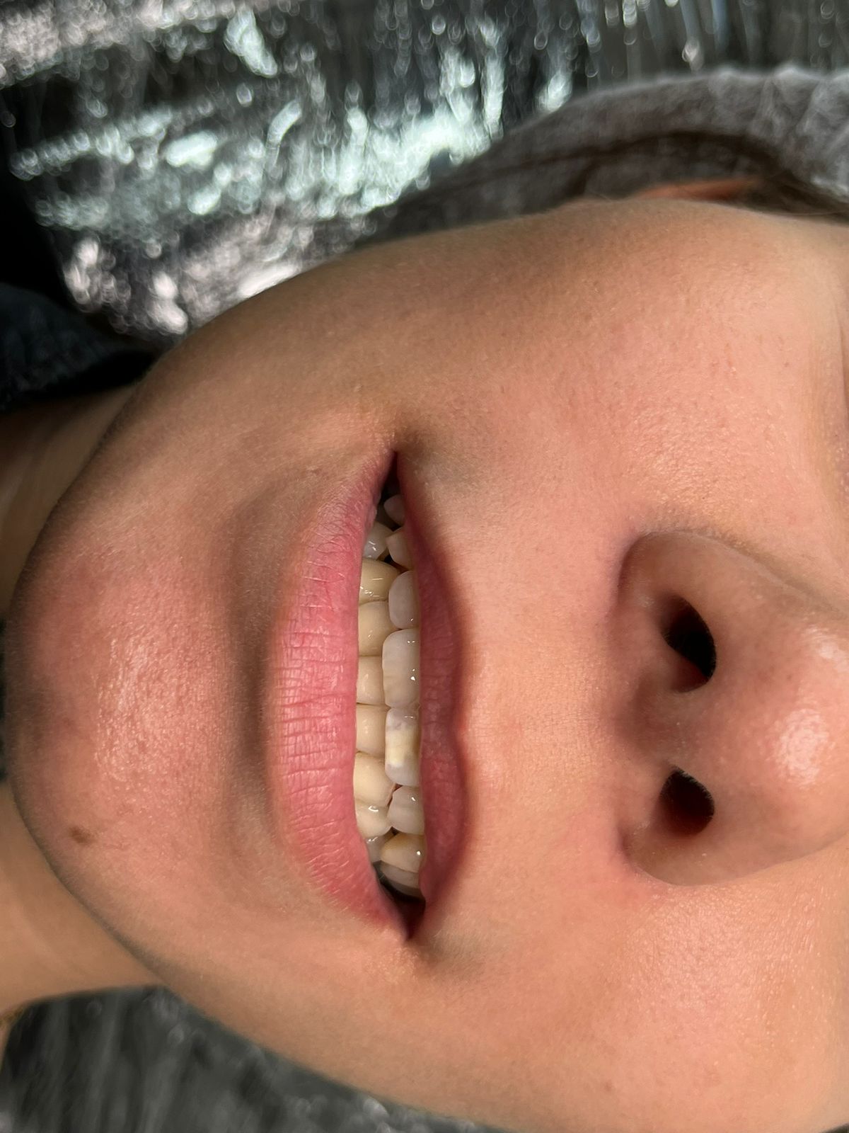 Antes do procedimento 0