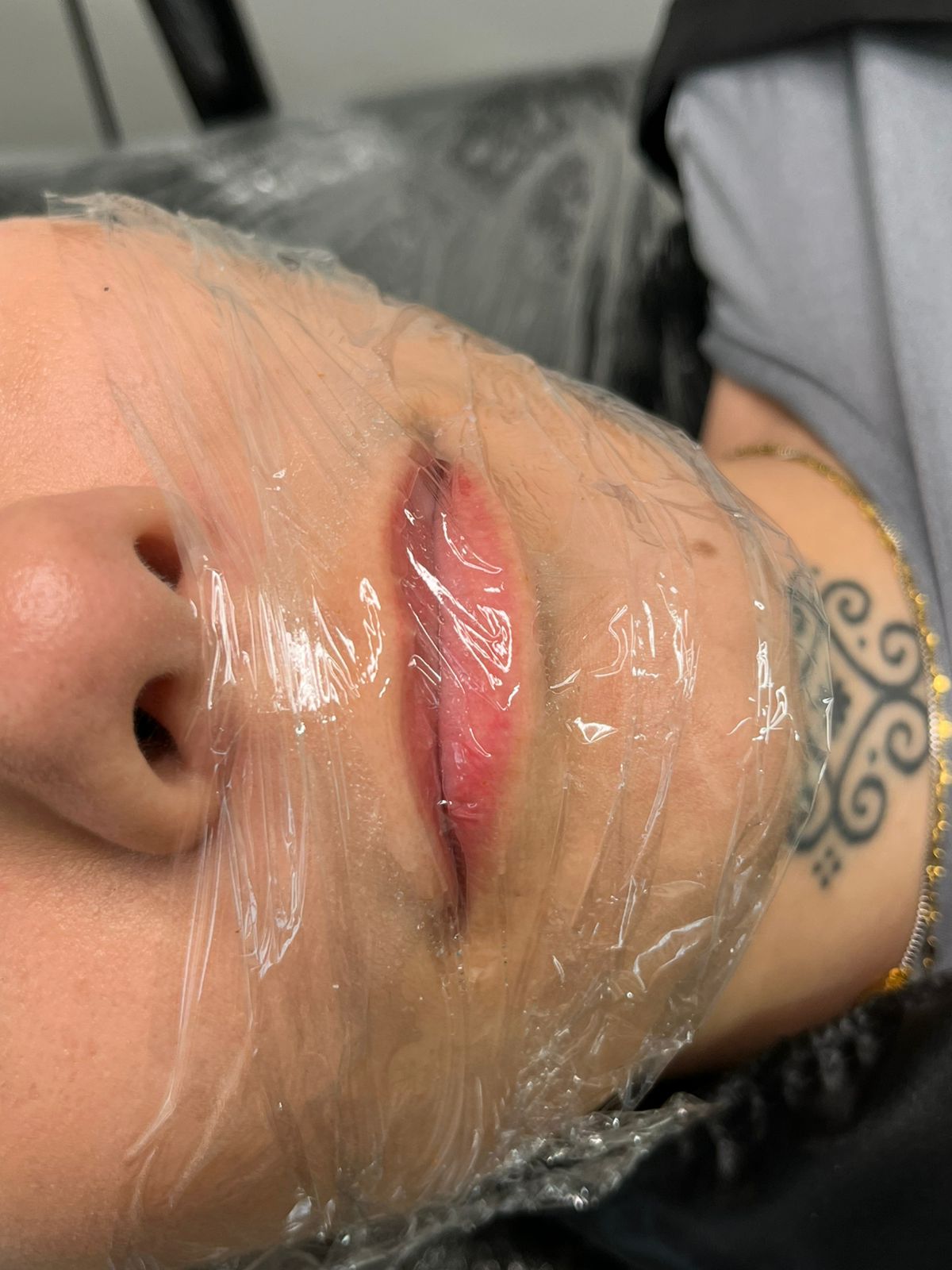 Antes do procedimento 1