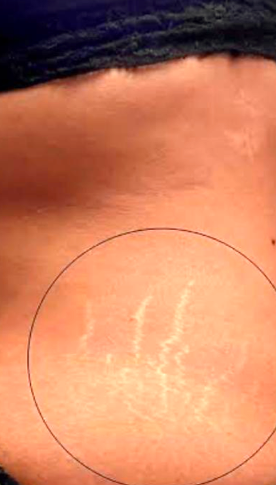 Antes do procedimento 3